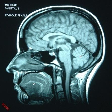 Médio RM crânio coronal T1 11