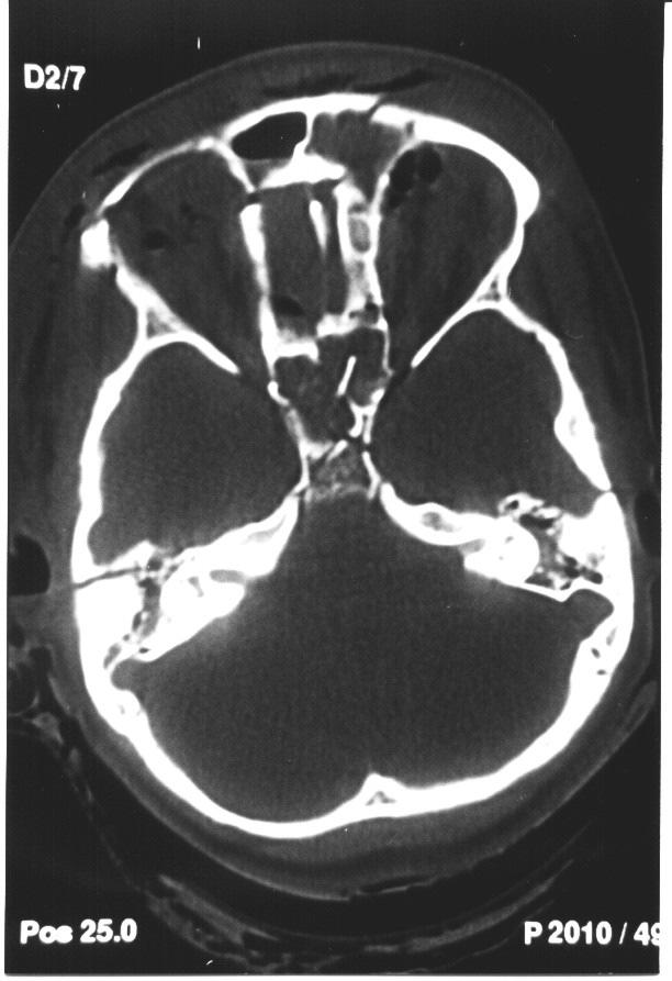 axial: janela óssea-rp HEMATOMAS /