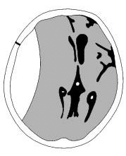 meníngea média ou seios durais Extra-axial