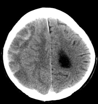 jenelas-cr 20 l: hematoma subdural