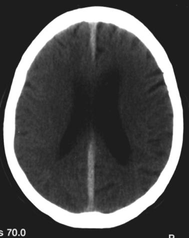 Não lembra de trauma-cr 22 Hematoma