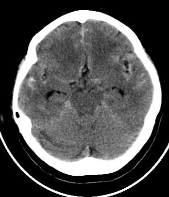 HEMATOMA SUBARACNÓIDE TC crânio