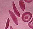 Micrócitos Diminuição de tamanho. Anemias associadas a deficiência de ferro; talassemias.