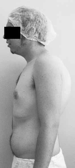 710 A B Holger Scheuermann descreveu, em 1921, uma alteração vertebral juvenil cifótica que poderia ser distinguida da cifose postural baseada na rigidez peculiar (1).