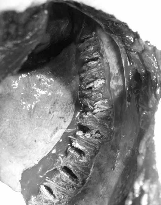 712 A B orifício. Com um palpador maleável confirmava-se a presença de osso nas paredes superior, inferior, medial, lateral e no fundo do trajeto (22).
