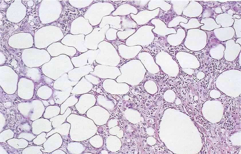 Tecido adiposo infiltrado de