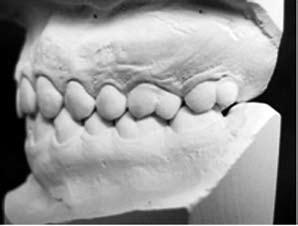 numa amostra de brasileiros, leucodermas, com oclusão normal natural, selecionados de acordo com os critérios propostos por Angle 3, o que denominou de oclusão normal.