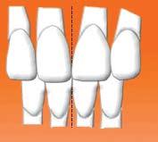 1) a cúspide mesio-vestibular do primeiro molar superior permanente ocluindo no sulco entre as cúpides vestibulares mesial e mediana do primeiro molar
