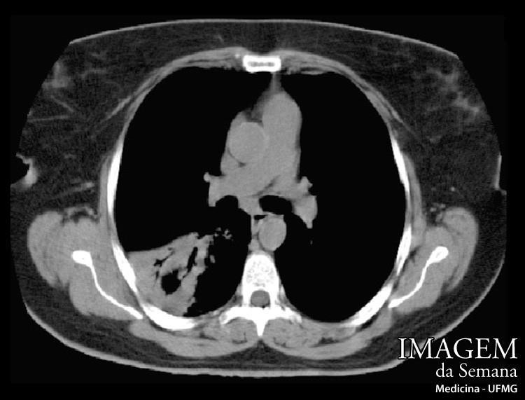 Imagem 03: Tomografia computadorizada do tórax, técnica de alta resolução, sem meio de contraste intravenoso.