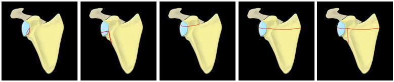 V) Combinação do tipo IV com fratura da borda inferior da glenoide. Figura 11. Fraturas intra-articulares da glenoide segundo Ideberg: Tipo I a V (da esquerda para a direita). Fonte: http://radclass.