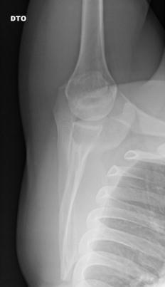 Figura14. Posicionamento e resultado radiográfico para a incidência de perfil da glenoide. Apresenta-se a seguir o protocolo a ser usado consoante a informação clinica (Figura 15).