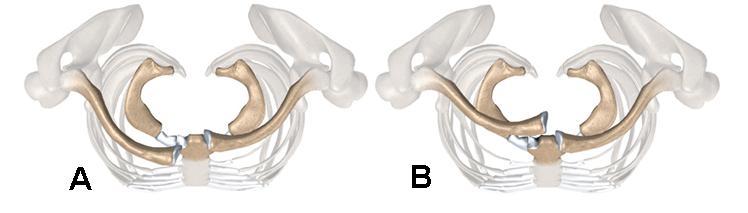 5. LUXAÇÃO DA ARTICULAÇÃO ESTERNOCLAVICULAR CLASSIFICAÇÃO PATOLÓGICA E INCIDÊNCIAS APROPRIADAS A articulação esternoclavicular situa-se entre a extremidade medial da clavícula e o manúbrio do esterno.