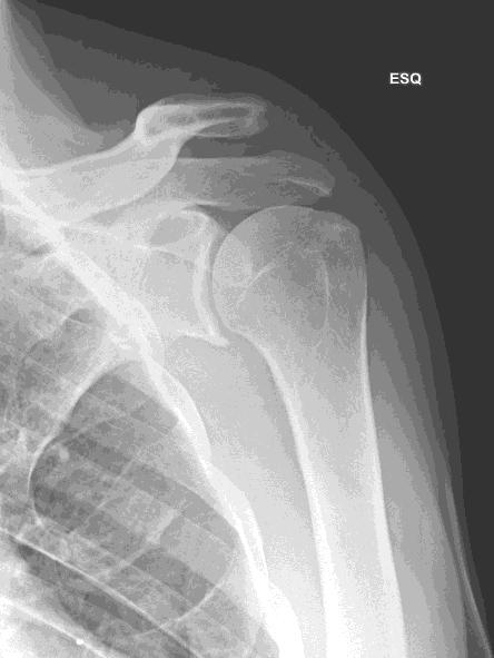 tomografia computorizada (TC) efetuada no mesmo dia. A TC veio confirmar uma luxação acromioclavicular de grau V e uma esclerose subacromial.