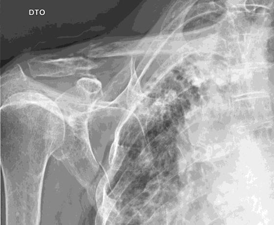 acrómioclavicular.