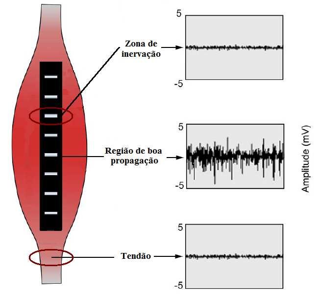 12 Outro benefício da disposição linear de eletrodos é a identificação da anatomia das unidades motoras e o mapeamento de regiões de boa propagação do sinal eletromiográfico (Merlleti et al., 2003).
