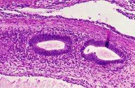 Neoplasias Neoplasia primária excisada sem tratamento dirigido, sem evidência de recidiva V10.