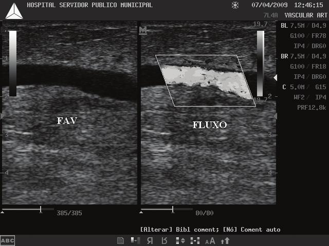 Perviedade precoce das fístulas arteriovenosas - Neves Junior MA et al. J Vasc Bras 2011, Vol. 10, Nº 2 109 Figura 3. US Doppler mostrando FAV maturada com fluxo adequado.