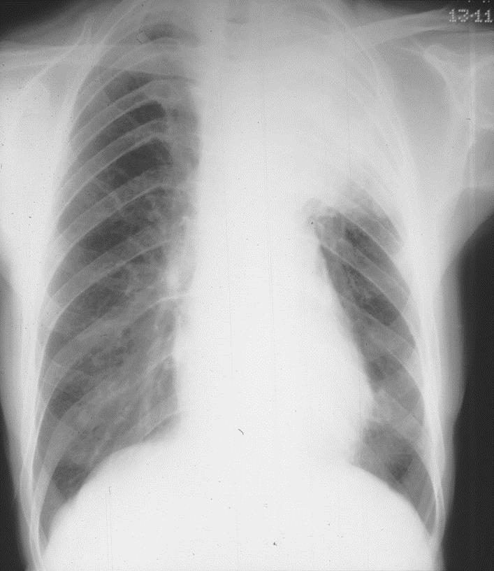 pulmonar Tomografia
