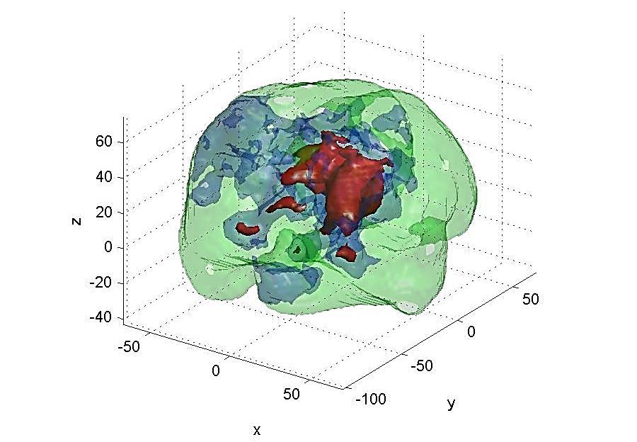 Figura 8 - Renderização 3D de estudos PET cerebrais https://www.stat.uchicago.edu/faculty/inmemoriam/worsley/research/surfstat/index.htm 3.1.