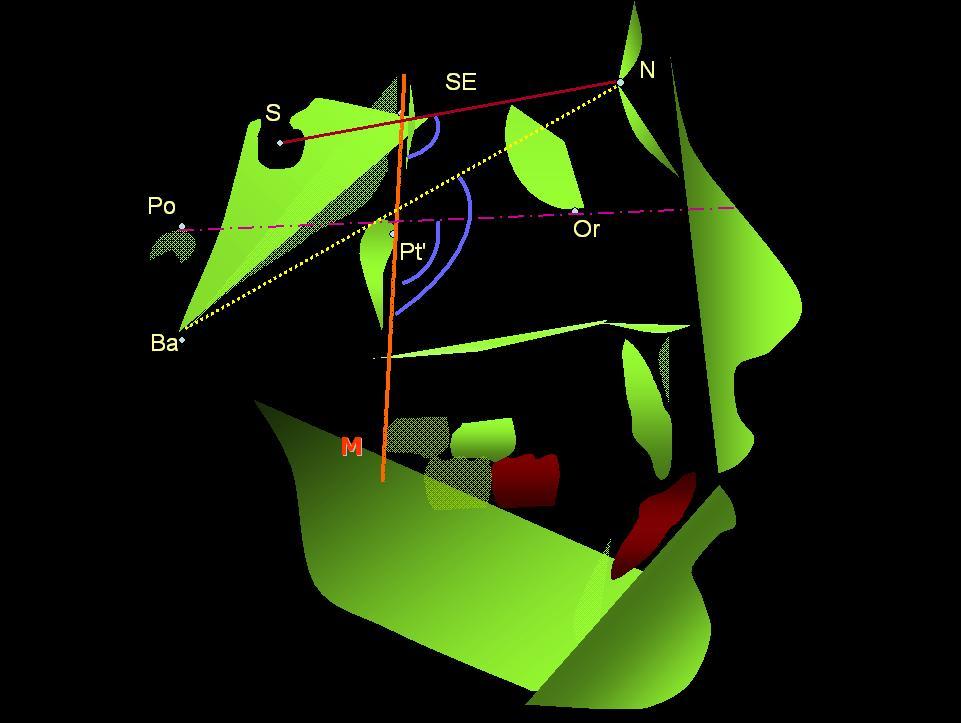 Material e Método 38 FIGURA 8 Representação dos ângulos cefalométricos das telerradiografias de indivíduos com má oclusão de Classe III de Angle Para a obtenção das médias dos valores de conversão