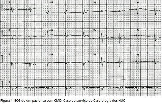 Em pacientes com uma história clinica, sintomas e achados ao EO que sugerem doença miocárdica, é normalmente usada uma combinação de electrocardiograma (ECG), RT e
