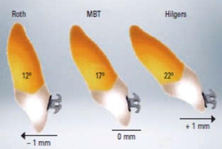 Manutenção do torque posterior durante a expansão do maxilar e adaptação óssea; Minimização dos movimentos indesejáveis e individualização em relação às diferentes mecânicas (elásticos, propulsores