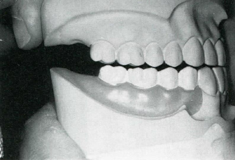 Anexo 5 Anexo 4 in McGivney & Carr, 2000 Guia Incisiva A guia incisiva promove a desoclusão dos dentes posteriores,