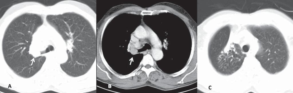 Figura 1. Lesão característica de carcinoide típico. Imagens axiais de TC do tórax após a administração de meio de contraste iodado intravenoso.