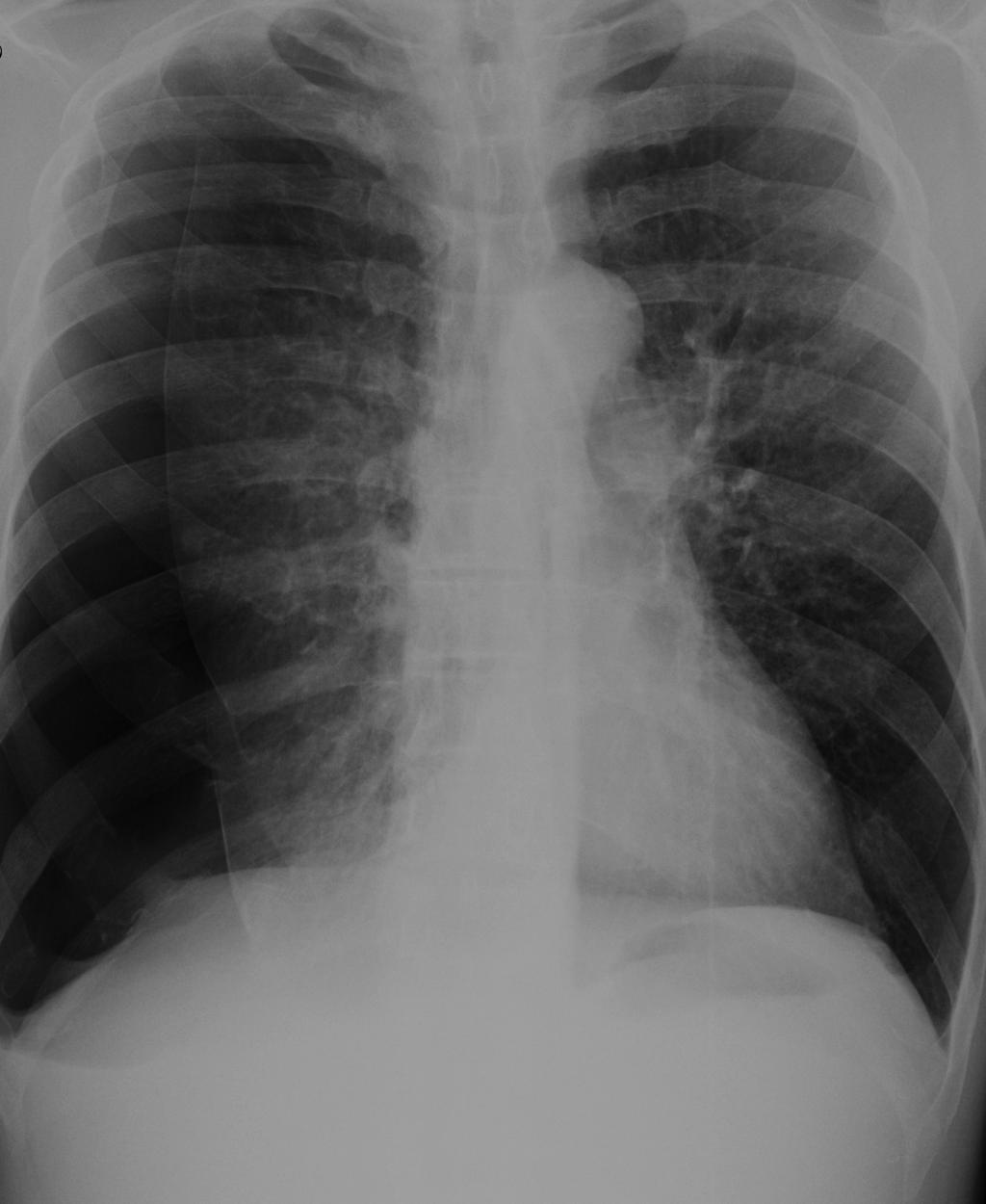 identificado como aumento da transparência do hemitórax associado a ausência das imagens da vasculatura pulmonar normal, principalmente na periferia e aspecto superior da imagem em PA.