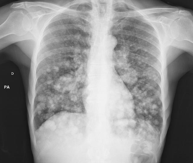 Múltiplos nódulos pulmonares e aumento do volume hilar bilateral por linfonodomegalia. Paciente com doença metastática. Massa: lesão torácica, pulmonar ou não, que mede mais que 3,0 cm de diâmetro.