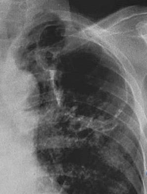 Bronquiectasia: na radiografia simples a imagem de bronquiectasia pode não ser característica, muitas vezes confundindo com