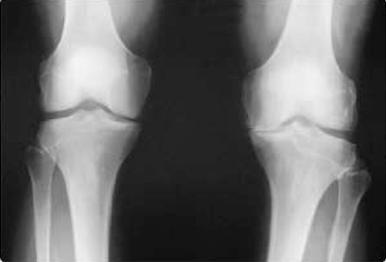 7 Figura 1.1 Radiografia representativa da articulação de Joelho humanos com OA.