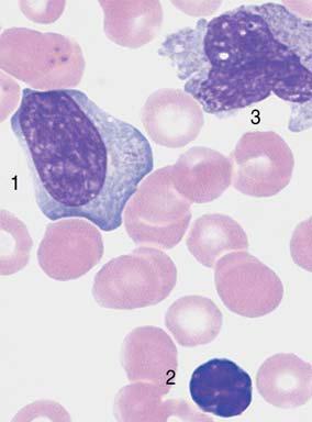 reactive virocytes in Epstein Barr virus (EBV) infection.