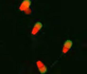 Células com membrana plasmática lesada, acrossomo lesado e sem potencial mitocondrial (LLS) (seta) e células com