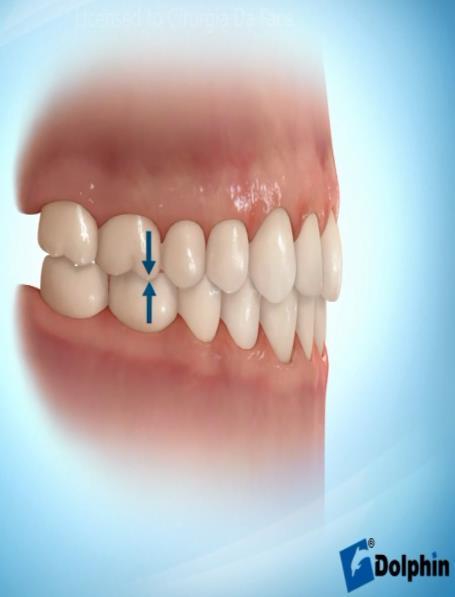 Comprimento do lábio inferior (porção mais superior do lábio inferior a Me'). 5. Espaço interlabial. 6. Exposição dos incisivos superiores. 7. Altura maxilar. 8.