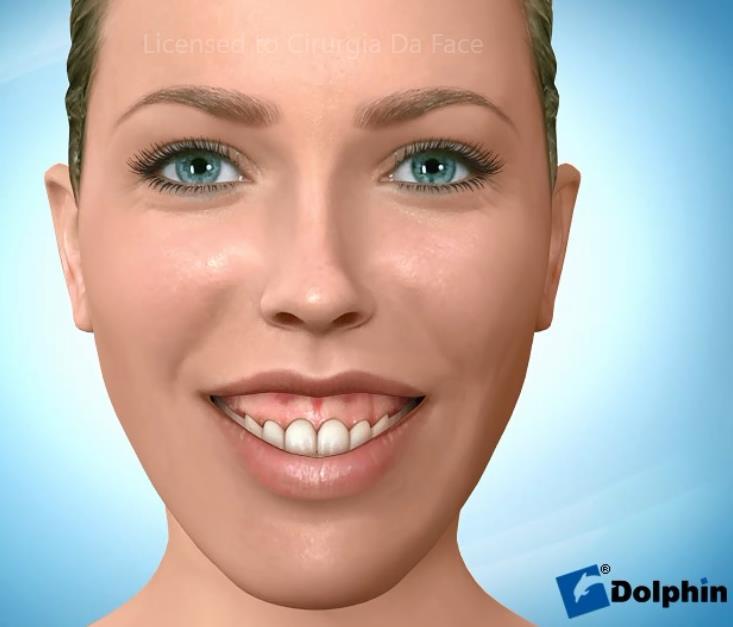 mandibular). Existe uma evidente redução do espaço aéreo nos pacientes que cursam com SAOS, principalmente ao nível da úvula e plano mandibular.