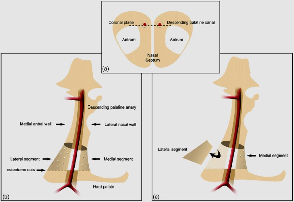 para a maxila, particularmente nas osteotomias segmentares, além da remoção da obstrução mecânica óssea.