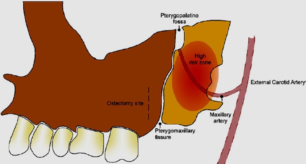521 Fig. 2 - Visão lateral da região pterigomaxilar esquerda mostrando o local da osteotomia da tuberosidade maxilar na osteotomia Le Fort I. Fonte: O REGAN, B.; BHARADWAJ, G.