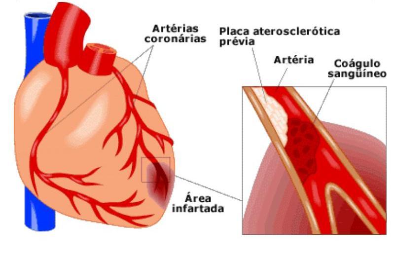 Infarto do miocárdio