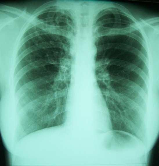 19 específica do parênquima pulmonar, consiste na aquisição de cortes finos, normalmente com 1,0 mm de espessura e espaçamento entre esses cortes de 10,0 mm.
