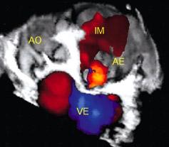 Volume regurgitante mitral estimado em 13,5 ml. A seta indica excentricidade e complexidade no formato do jato regurgitante. Figura 9.