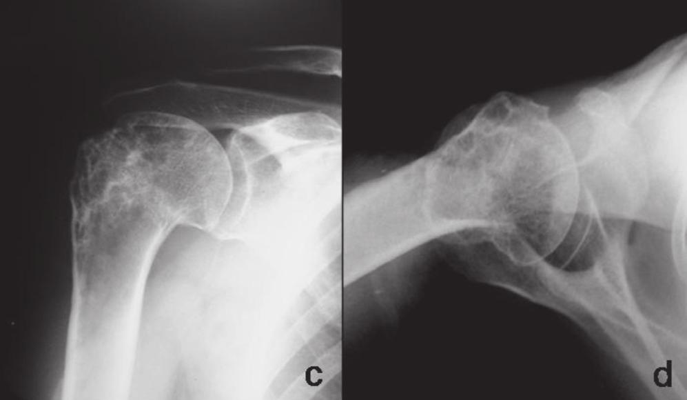 tubérculos maior e menor e ausência de desvio da cortical medial; b) Radiografia do período pós-operatório imediato mostrando