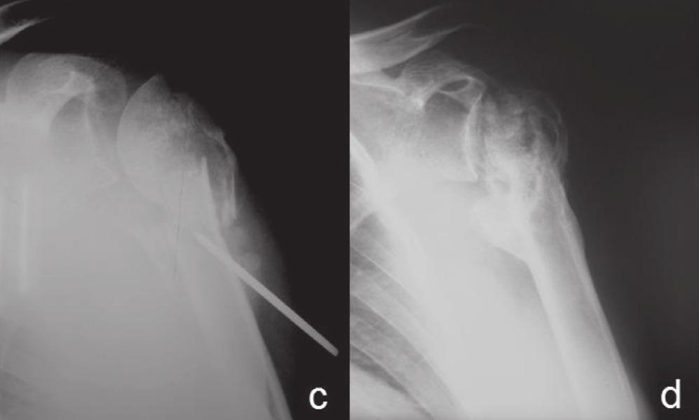 Figura 5 Caso 8: avaliação radiográfica: a) Radiografia de frente no período pré-operatório; b) Radiografia de frente no