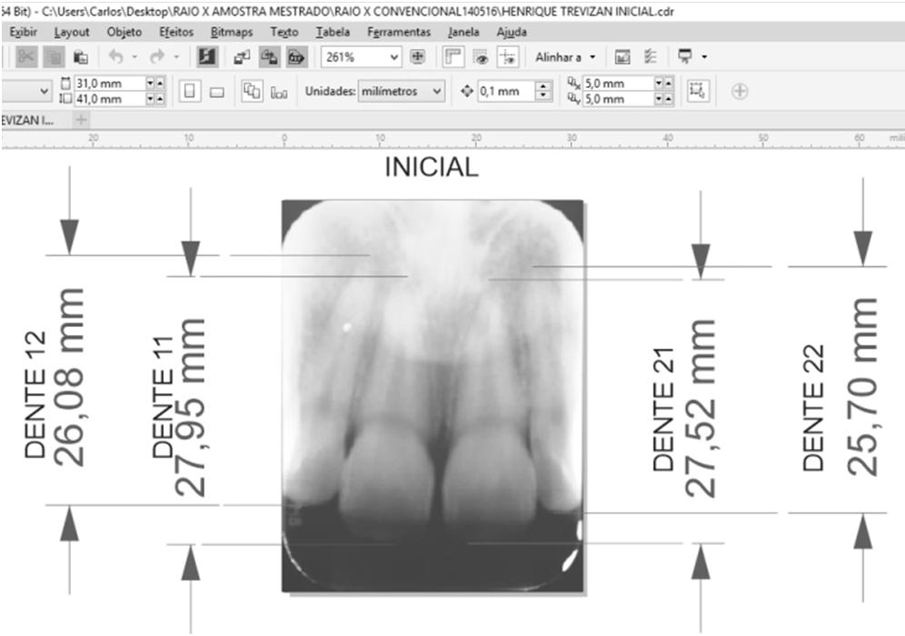 32 4.3 Método As radiografias periapicais das fases inicial (T1) e final de nivelamento (T2) foram obtidas em clínicas particulares utilizando filmes radiográficos convencionais.