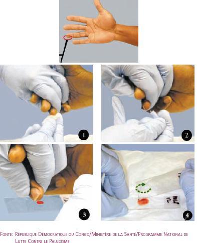 O sangue deve ser colhido com uma lanceta na face lateral da polpa digital do dedo anular, estando limpo e seco para se evitar a hemólise das hemácias 1.