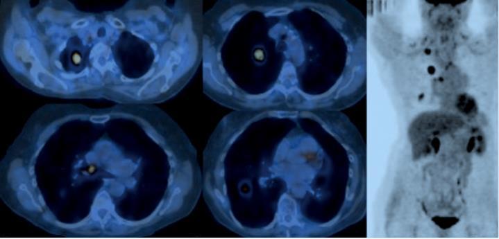 115 Figura 1 PET/CT (esquerda) e PET (direita) realizados para o estadiamento de um paciente com diagnóstico de câncer de pulmão de células não pequenas. Fonte: Hochhegger et. al. (2015).