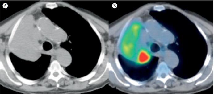 116 radioterapia para câncer de pulmão. Observa-se a diferenciação entre o tumor e as estruturas adjacentes com o uso da PET/CT, auxiliando no planejamento radioterápico.