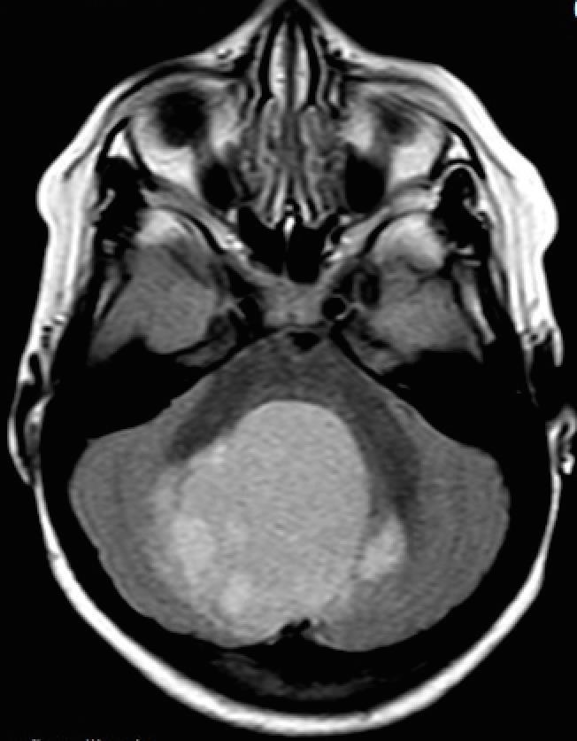 Astrocitoma pilocítico OMS grau I - O mais comum tumor glial da infância Disseminação