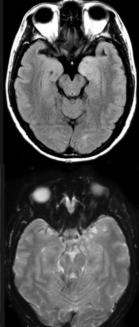 DNET Jovens < 20 anos Excelente prognóstico Parte do espectro da Displasia cortical Corticais lobo temporal (mais comum mesial) Crescimento lento Excelente prognóstico 1-2 a