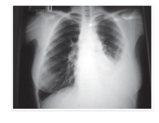 Radiografia do Tórax Ecocardiograma DIAGNÓSTICO DE ENFERMAGEM Troca de gases Prejudicada CARACTERISTICAS DEFINIDORAS Cor da pele anormal, dispneia, taquicardia.